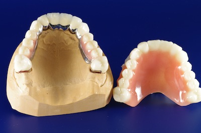 Zweitprothese Zahntechnik Schumacher